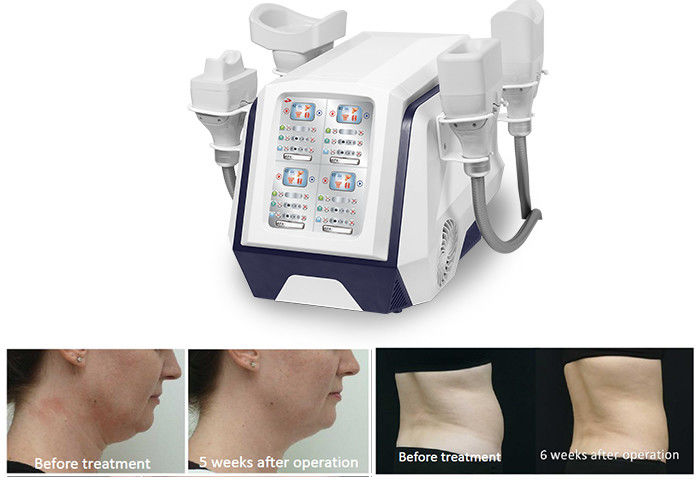 Tragbarer 360 Cryolipolysis Körper, der Maschine 1000W für fetten brennenden Gewichtsverlust abnimmt